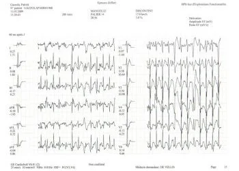 Exemple Tracé Cardiaque à 17 km/h
