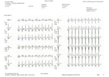 Exemple Tracé Cardiaque à 12 km/h